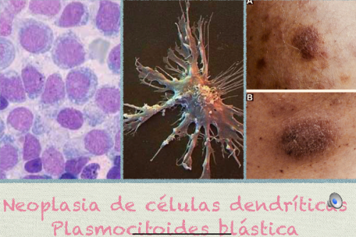 Leucemia de Células Dendríticas 